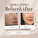 생활 속의 주역 | 강남언주역피부과 실펌엑스 x 진정케어 꿀조합 모공없는 꿀광피부