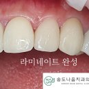 송도나음치과의원 | 송도나음치과 라미네이트