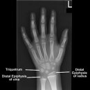 골연령 평가[bone age test]질환이란? 이미지