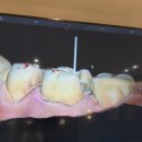 크라운치과기공소 티스토리
