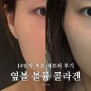필업100 | 신사역피부과 필업 볼륨콜라겐 옆볼 효과 2주 후기