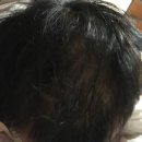 유희승한의원 | 유희승한의원 원형탈모 치료