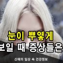 평소 '눈이 뿌옇게 보여요' 생각하는 분들의 의심 증상 이미지