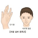 러셀 실버 증후군(Russell-Silver syndrome) 유전질환이란? 이미지