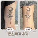 전병원 | 피코레이저문신제거 남양주별내피부과 왕만족 후기 최근 나의 일상 (2)