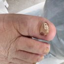 레푸스앤두두뷰티 | 의정부 문제성 발톱 관리, 레푸스 앤 두두뷰티 2차 관리 후기 ( 어머님 발 건강 지키기)