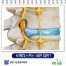 성북구 허리디스크 반복되는 통증 있을 때