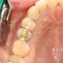 보강치과기공소 이미지