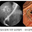 담석증 원인 담도암 증상 초기 말기 생존 기간 치료 이미지