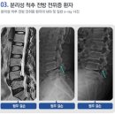 [부천역 신경외과] 척추전방전위증의 치료방법 이미지