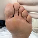 A1171 | 아산발각질 굳은살 고민 싹 없앴어요!