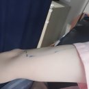 은혜건강원 | 밍쏠쏠의 팔뚝지방흡입 후기 1탄