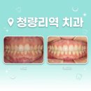 안아픈디지털치과의원 | 청량리역 치과 추천 청량리교정치과 통증 적은 교정 방법