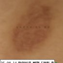 변증의 새 | &#34;2년 여간 전신을 괴롭히던 습진&#34; 이제 끝이 보여요