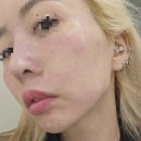 송도피부과에서 통증없는 스킨부스터 콜라스터포텐자 시술후기
