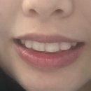 내돈내산찐후기) 티유치과_제로네이트 장단점 및 후기 before/after 0