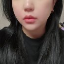 부평역전 지구대 옆 | 인천 부평 피부과 입술필러 만족 후기!