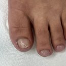 진주신발 | 🐟 “진주무좀발톱 때문에 신발 벗기가 스트레스였다면…”레푸스진주 대안점 관리후기