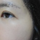 참조은피부과의원 | [세종피부과] 나성동 잇츠미의원 내돈내산 점빼기 + 미백 피코 토닝레이저 효과 후기