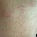 천욱부피부과의원 | 서면 찐 피부과 추천 천욱부피부과 두드러기