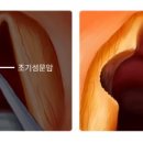 작은후두암