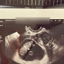 (주)창신종합중기정비 | 시험관 시작 2개월 만에 임신, 동탄제일아이희망의원 병원 선택 이유