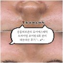 2022 제6회 영 | 강릉피부관리 | 듀이에스테틱 | 트라이엄 포어핏 6회 내돈내산 후기