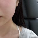 개인생활펫 | 홍대피부과 얼굴제로펫 2회차 후기, 얼굴 살빼는 시술, 심부볼살 빼기