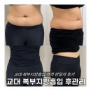 바이오 - 청주시 서원구 두꺼비로30번길 18 | 교대 복부지방흡입 가격 한달 흉터 바이오본드 관리후기