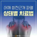 어깨 회전근개파열(상태별 치료법) 이미지