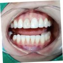 트리베일러(Baylor)치과의원 | 용인 치아미백 트리베일러치과 덴탈에스테틱 후기 누렁니가 하얗게 (가격)