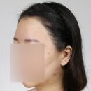 그녀의헤어라인의원 | 입체적인 측면 만들어주기! 모류의 중요성! feat.3500모 여성헤어라인+관자놀이+구레나룻 절개모발이식