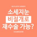 소세지눈 붓기 안빠지는데 비절개 쌍수 재수술로 해도 되나요? 이미지