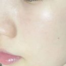 건제약국 | 약국 좁쌀여드름 연고? 피부과? 이 조합이 최고 [내돈내산]