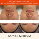 대구학정초등학교 | 대구 북구 피부관리 학정동 가율메디스파 멜라소닉 화이트토닝 만족 후기