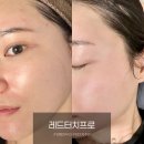 센텀5로 | 부산 센텀 피부과 레드터치프로 콜라겐 탄력 레이저 내돈내산 후기