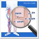 하지정맥류종류, 구분법은? 이미지