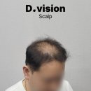 디비전 스칼프 이미지