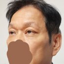 참편한하신경과의원 | 남자도 눈밑지방재배치 괜찮을까 고민하다가 저희 아빠 이번에 눈밑지 해드렸어요