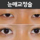 Re:눈매교정 쌍꺼풀 문의 - 다우성형외과 답변입니다. 이미지