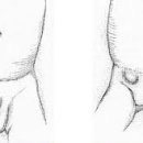 소아 탈장[pediatric inguinal hernia] 이미지