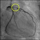 협심증이란 이미지