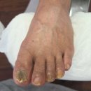 레푸스남양주블루밍네일 | <더네일 앤 레푸스진접점>에서 경험한 놀라운 발톱 건강 되찾기:)!!