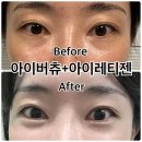 선릉역피부과 아이버츄와 아이레티젠으로 눈가주름 고민 해결
