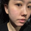 신사 피부관리 여드름전문 꼼에스테틱 신사본점 후기
