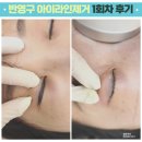 시흥 배곧/장곡동 아이라인문신제거 1회차로 맑고 퓨어해지는 중(feat 미작뷰티)