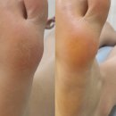 로제토뷰티 | 인천 가정역 패디스케일링 여름맞이 발각질제거 로제토뷰티 루원시티점 후기