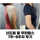 (주)무한 | 신도림 팔 무한람스 찐후기 (7주~8주차, 비용, 후관리, 멍, 붓기, 바본)