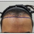 헤어로의원 | [대다모 포토후기] 전주 헤어로의원 비절개 모발이식 2600모 14일 경과 후기입니다.