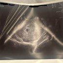 보건온누리약국 | 임신 5주차 임테기, 초음파(작은 아기집), 증상, 출혈, 검사, 영양제 그리고 감기를 곁들인